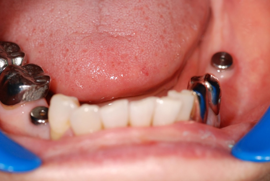 Corident Corimplant Trays_6.jpg