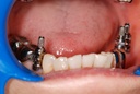 Corident Corimplant Trays_7.jpg