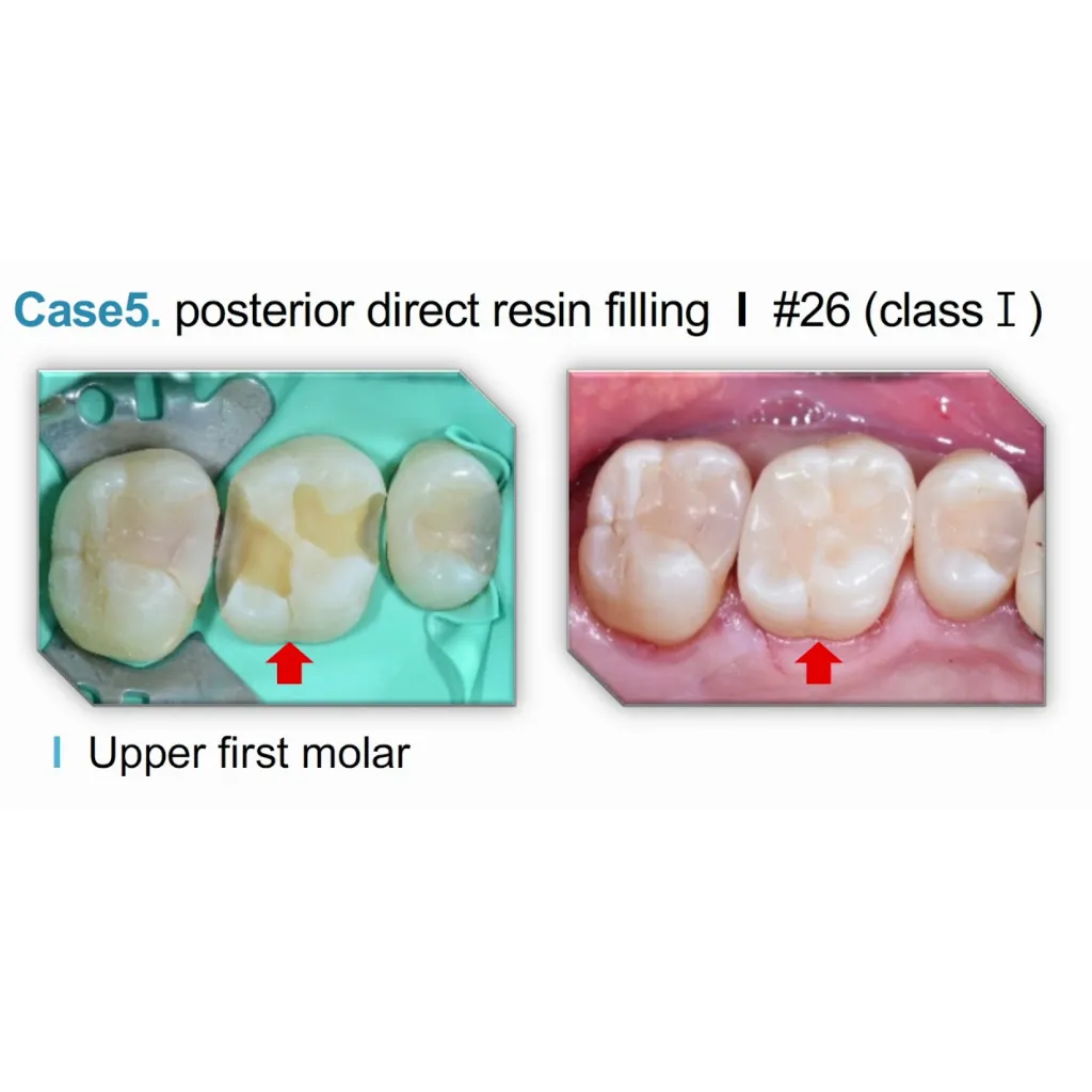 Spident EsCom250 NanoHybrid Composite System Kit_3.jpg